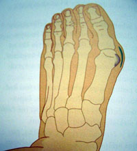 Hallux valgus